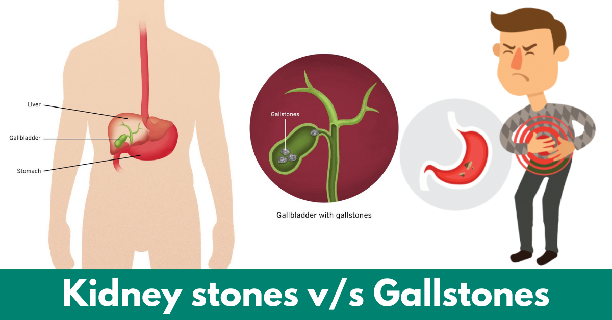 Kidney-stones-vs-Gallstones