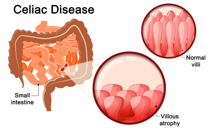 celiac-disease-gluten